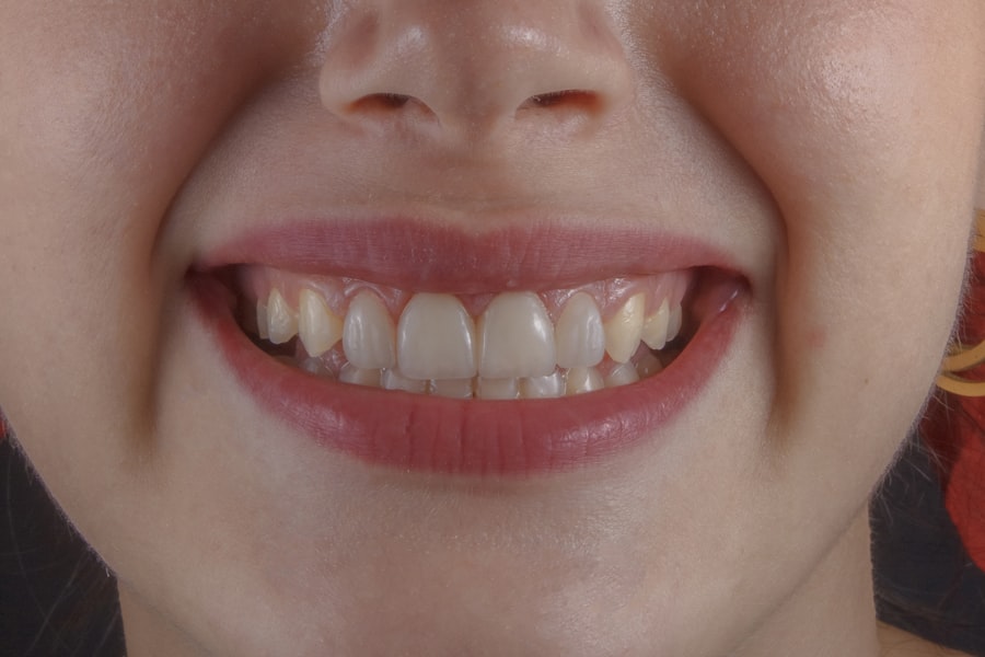 Blanchiment dentaire, sourire éclatant